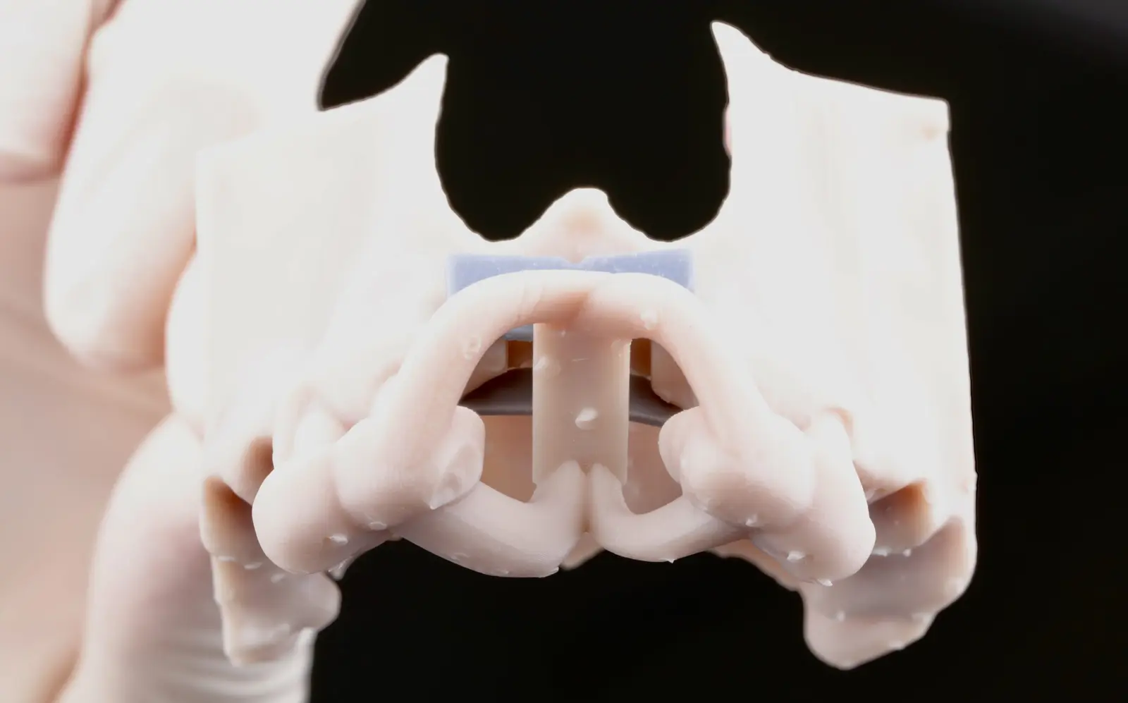 3D-printed maxillary model with a surgical guide